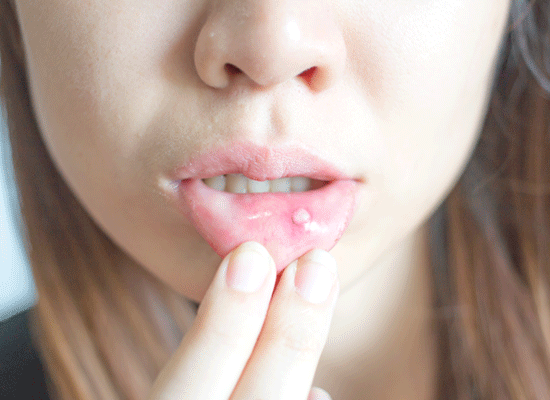 Læben sår på Hudkræft