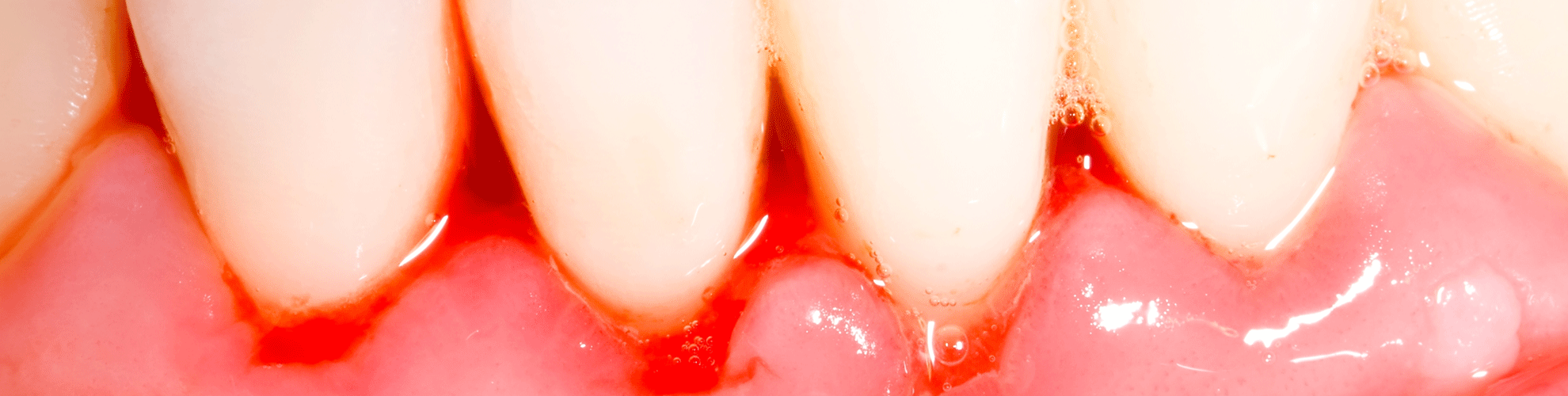 Tandkødet kræft i 💊 Mund