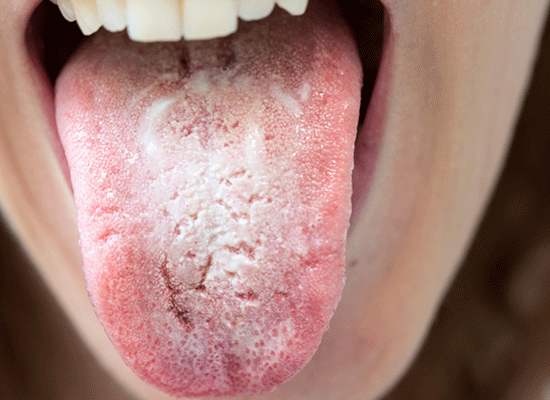 Candida albicans på tunge