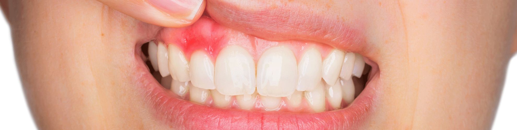 Tandkødsbetændelse