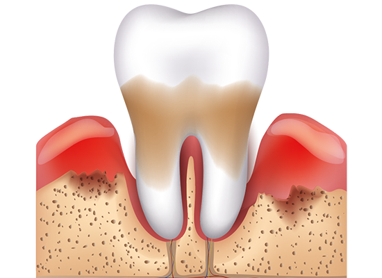 Parodontitis