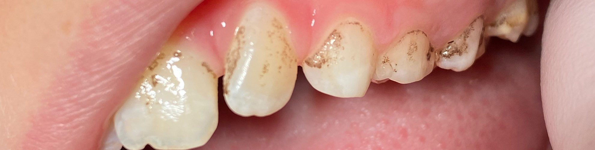 Kor detektor Il Sorte pletter på tænderne hos børn (black stain) | Danske Tandplejere