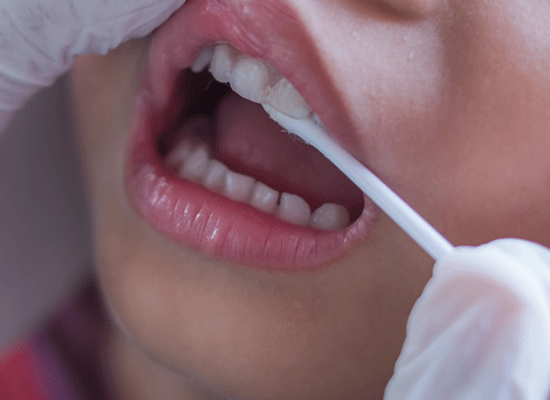 Fluoridbehandling
